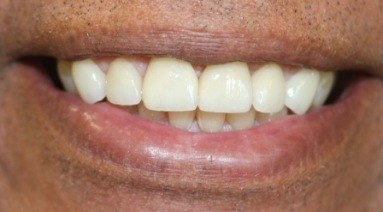 Flawless smile after cosmetic dentistry in Ledgewood