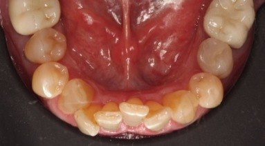 Crooked bottom teeth before orthodontic treatment