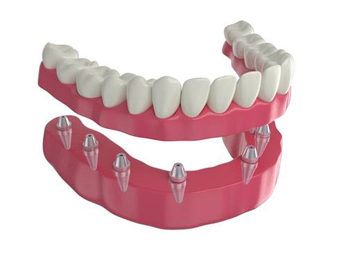 Illustration of implant denture for lower arch