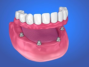 Model of implant-supported denture