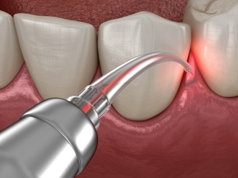 Animated smile during laser assisted periodontal therapy