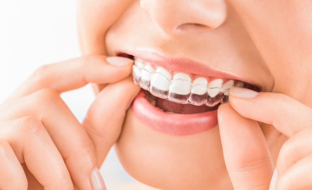 A woman putting on a ClearCorrect aligner.